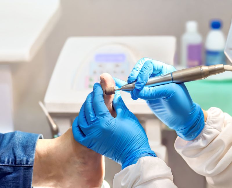 Tratamento de Unha Encravada - Helpé Podologia - Pé - Unha