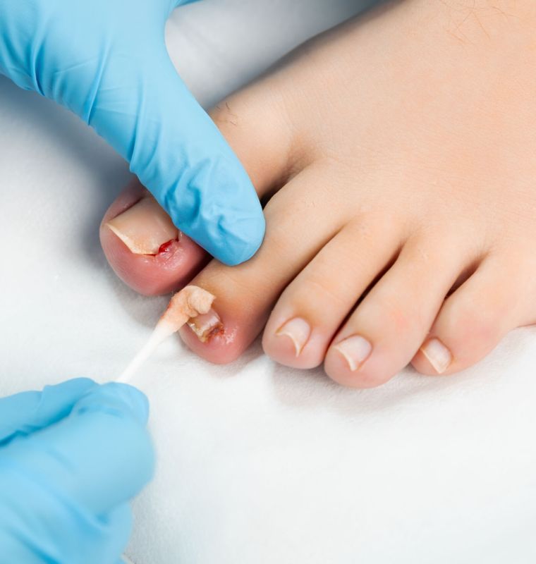 Tratamento de Unha Encravada - Helpé Podologia - Pé - Unha