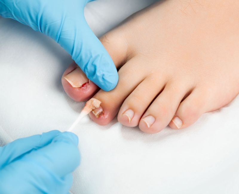Tratamento de Unha Encravada - Helpé Podologia - Pé - Unha