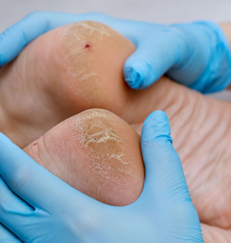 Tratamento de Rachaduras e Calos - Helpé Podologia