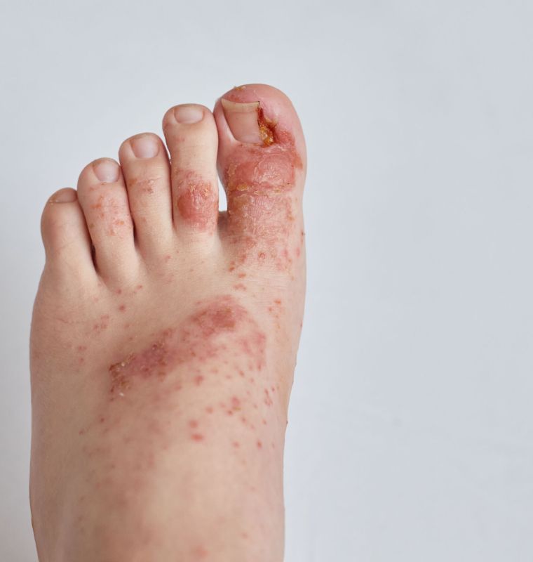 Tratamento de Micose de Pé - Helpé Podologia