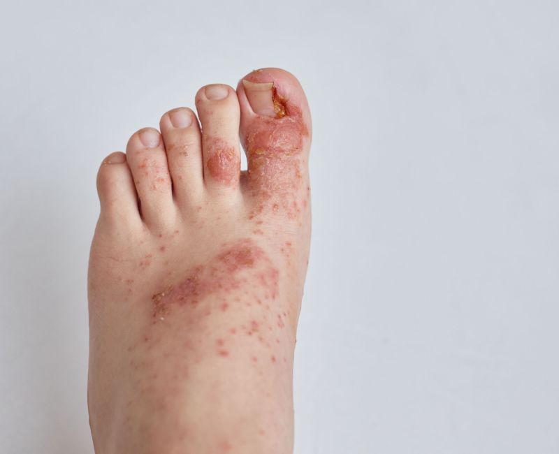 Tratamento de Micose de Pé - Helpé Podologia